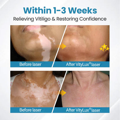 💥 2025 Hot Sale 70% OFF 🔥 VityLux® DermaBeam Vitiligo Laser Therapy System