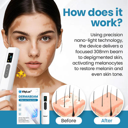 💥 2025 Hot Sale 70% OFF 🔥 VityLux® DermaBeam Vitiligo Laser Therapy System