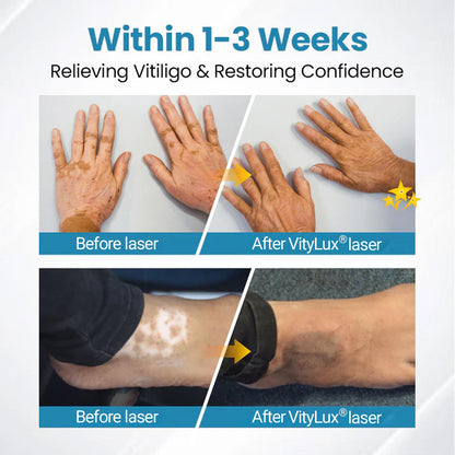 💥 2025 Hot Sale 70% OFF 🔥 VityLux® DermaBeam Vitiligo Laser Therapy System