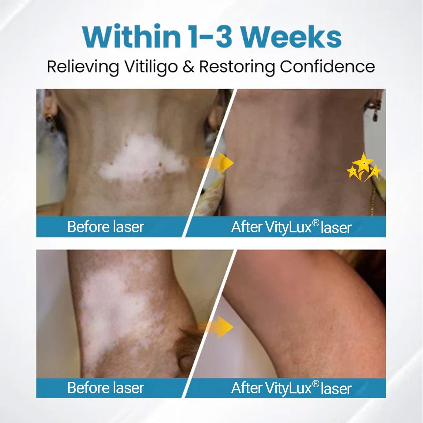 💥 2025 Hot Sale 70% OFF 🔥 VityLux® DermaBeam Vitiligo Laser Therapy System