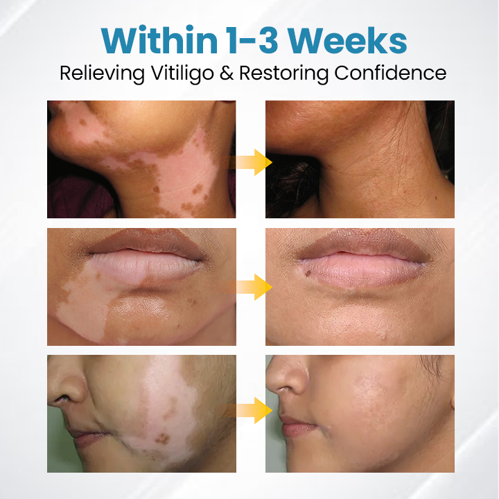 💥 2025 Hot Sale 70% OFF 🔥 VityLux® DermaBeam Vitiligo Laser Therapy System