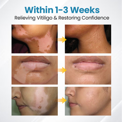 💥 2025 Hot Sale 70% OFF 🔥 VityLux® DermaBeam Vitiligo Laser Therapy System