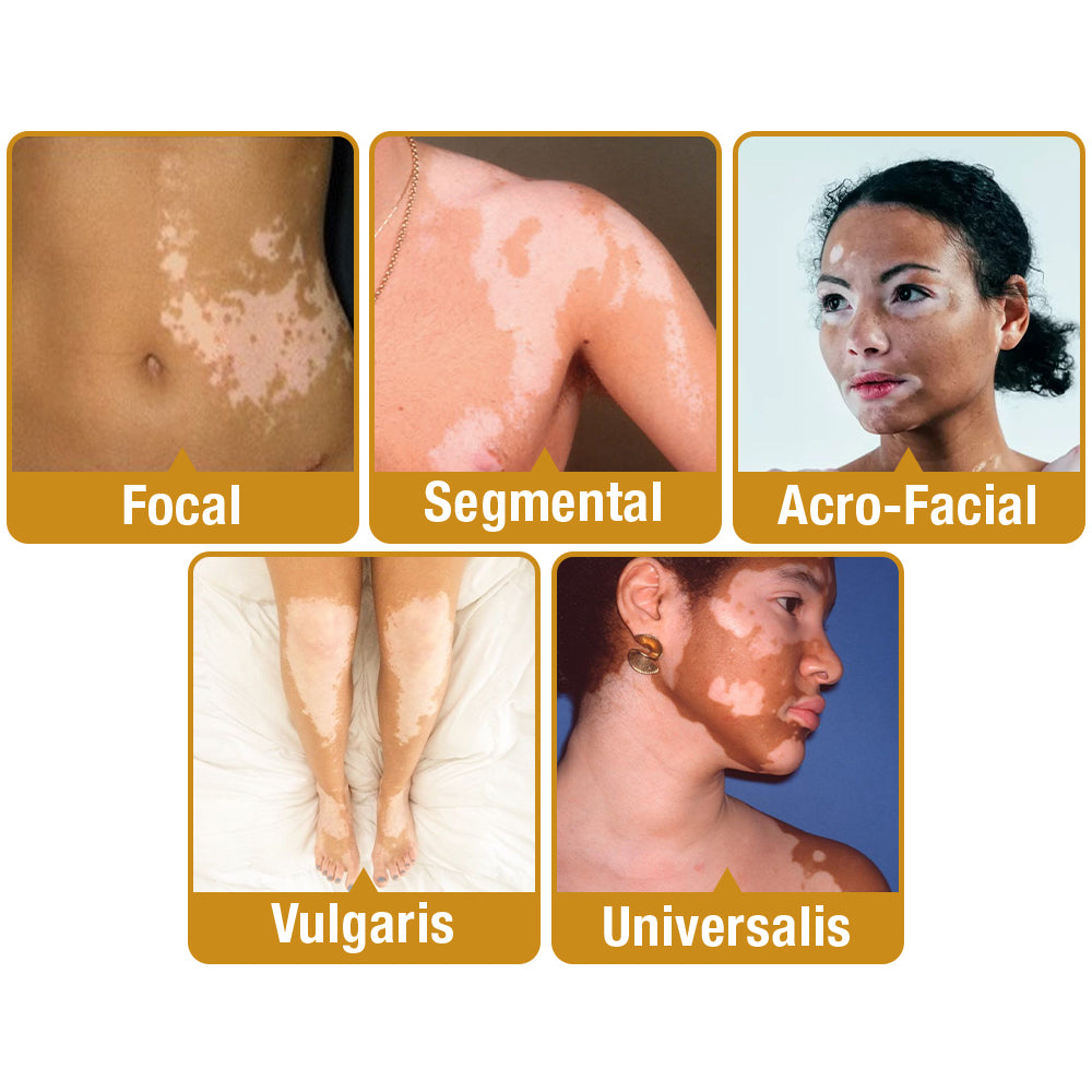 🔥 LAST DAY SALE 70% OFF 🔥 UNPREE™ VitiGO Bee Venom Treatment Cream - Bright Days Start With Clear Skin