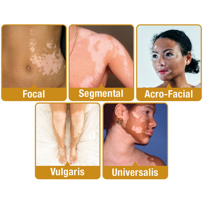 🔥 LAST DAY SALE 70% OFF 🔥 UNPREE™ VitiGO Bee Venom Treatment Cream - Bright Days Start With Clear Skin